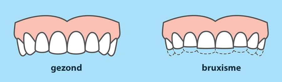 Effecten van bruxisme tanden knarsen